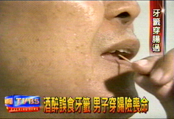 酒醉誤食牙籤 男子穿腸險喪命