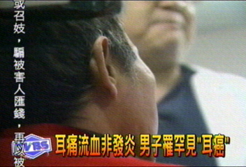 耳痛流血非發炎 男子罹罕見「耳癌」