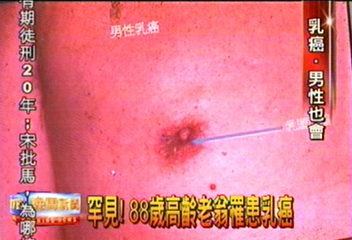 罕見！　88歲高齡老翁罹患乳癌