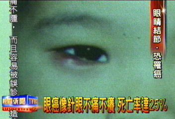 眼癌像針眼不痛不癢 死亡率達25%