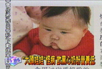 「大頭娃娃」怪病　飲黑心奶粉營養低