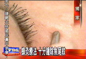 〈獨家〉蜂灸療法　10分鐘除魚尾紋