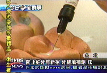 防蛀牙新招 牙縫填補劑 炫