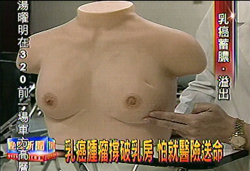 乳癌腫瘤撐破乳房 怕就醫險送命