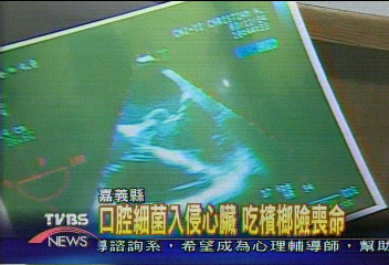 口腔細菌入侵心臟　吃檳榔險喪命