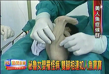 祕魯女嬰罹怪病 雙腳相連如人魚寶寶