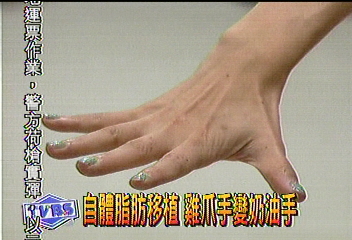 自體脂肪移植 雞爪手變奶油手