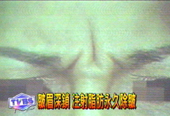 皺眉深鎖 注射脂肪永久除皺