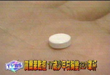 賀爾蒙戰痘　17歲少年右胸變32A罩杯