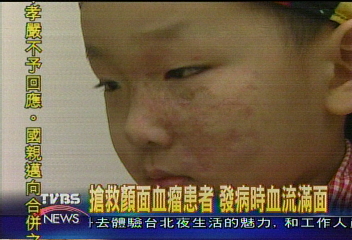 特別的記號 血管瘤患者分享心情