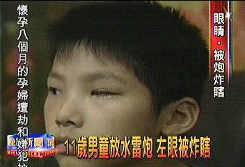11歲男童放水雷炮 左眼被炸瞎