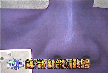 雷射美白 類風濕婦人變大黑臉