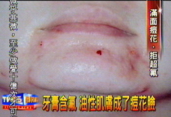 牙膏含氟 油性肌膚成了痘花臉