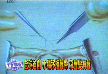 全球首創　小腸移植聲帶　沒聲變有聲