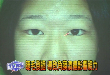 睫毛倒插　導致角膜潰瘍影響視力