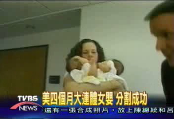 美四個月大連體女嬰 分割成功