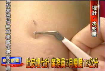 肚皮埋7針 業務員2月瘦腰12公分