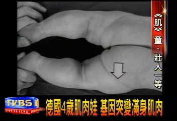 德國4歲肌肉娃　基因突變滿身肌肉