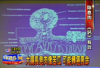 大腸長息肉像苦瓜　可能轉癌喪命