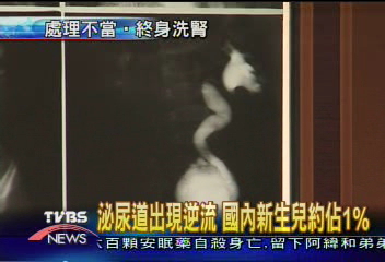 新生兒反覆發燒　泌尿道逆流作怪
