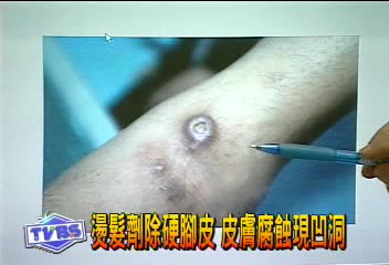 燙髮劑除硬腳皮 皮膚腐蝕現凹洞