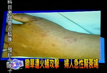 鋤草遭火蟻攻擊 婦人急性腎衰竭