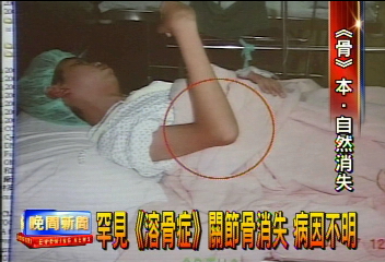 罕見「溶骨症」　關節骨消失　病因不明