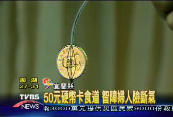 50元硬幣卡食道 智障婦人險斷氣