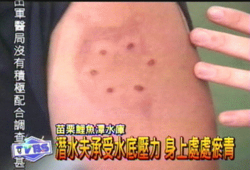 潛水夫承受水底壓力 身上處處瘀青