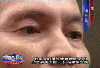 揉眼揉到瞎!右眼潰爛摘除 求償200萬