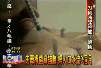 肉毒桿菌麻錯臉　婦人口水流3個月