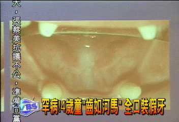 罕病！4歲童「齒如河馬」　全口裝假牙
