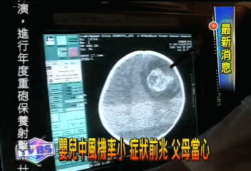 1歲男嬰摔下床　顱內出血腦中風不治