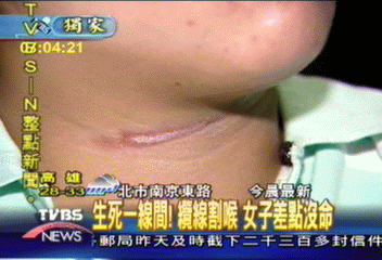 〈獨家〉生死一線間!纜線割喉 女子差點沒命