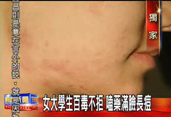 〈獨家〉女大學生百毒不拒 嗑藥滿臉長痘