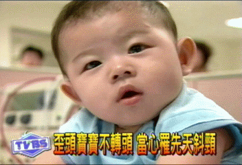 歪頭寶寶不轉頭 當心罹先天斜頸