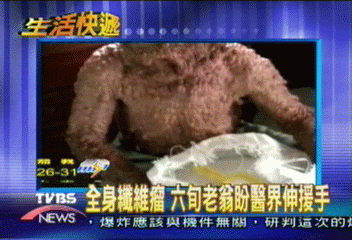 全身纖維瘤 六旬老翁生活陷困