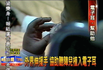 裝電子耳要價70萬 家庭沈重負擔
