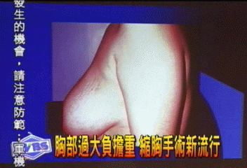 胸部過大負擔重　縮胸手術新流行