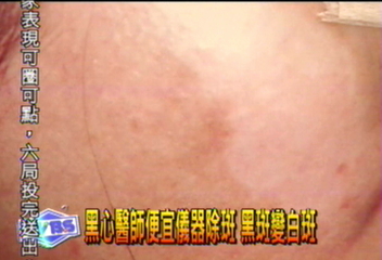 黑心醫師便宜儀器除斑 黑斑變白斑