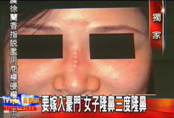 〈獨家〉要嫁入豪門 女子隆鼻三度隆鼻