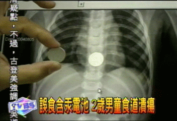 誤食含汞電池　2歲男童食道潰瘍