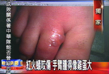 〈獨家〉紅火蟻咬傷　手臂腫得像雞蛋大