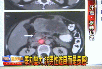 睪丸變大 非男性雄風而是長癌!