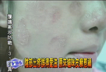 陰部出疹誤得愛滋 原來貓咪皮癬惹禍