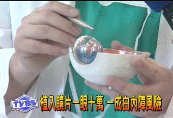植入鏡片一眼10萬 一成白內障風險