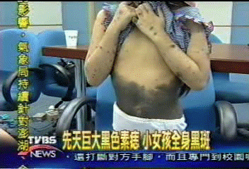 先天巨大黑色素痣　小女孩全身黑斑