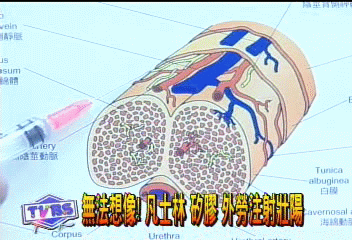 陰莖注射橄欖油 大了 毀了!