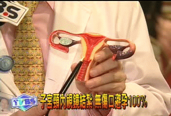 子宮頸內視鏡結紮　無傷口避孕100%