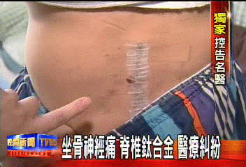 〈獨家〉坐骨神經痛 脊椎鈦合金 醫療糾紛